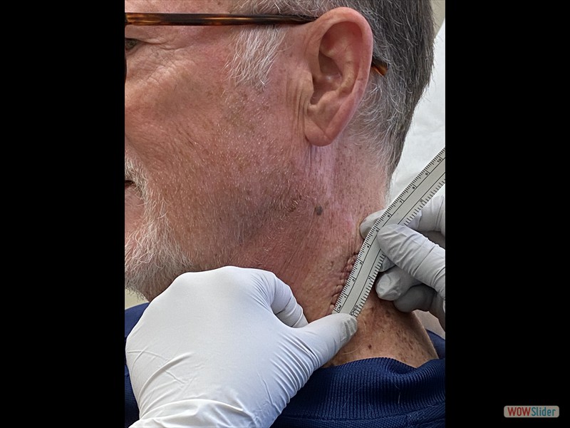 Phil's Mohs surgery